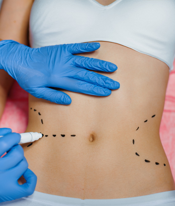 Eigenfettunterspritzung - Lipofilling in der Steiermark
