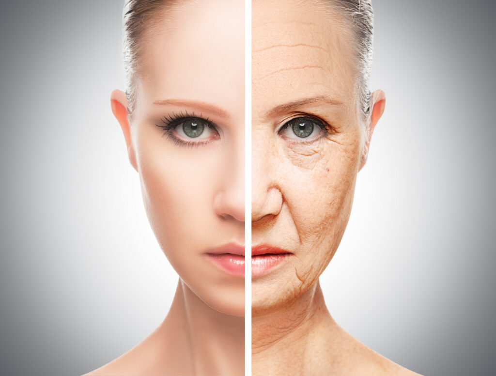 Gesichtsfalten reduzieren mit Eigenfettunterspritzung - Lipofilling